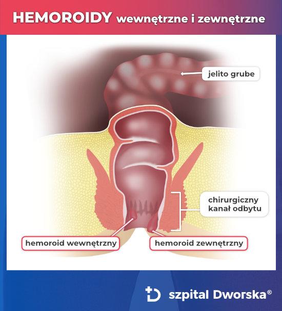 Hemoroidy Szpital Dworska